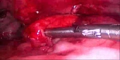 Epiploica laparoscopic resection in large bowel