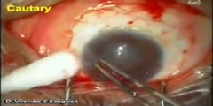 Amniotic membrane graft, eye keratectomy
