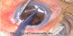 Keratoplasty the penetrating eye surgery