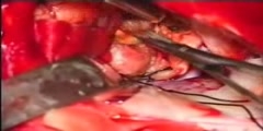Tumor Excision in 3rd Ventricular and Sellar