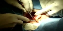 Skin cancer surgery; the ear reconstruction after