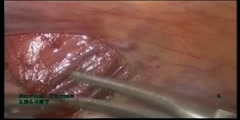 Laparoscopic varicocelectomy treatment