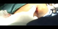 Lipoma removal minor surgery video