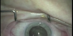 Phaco cataract surgery hd video