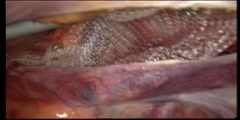 Repair of hernia by laparoscopic inguinal