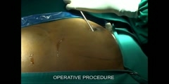 Male Breast Reduction & Correction of Gynecomastia By Dr MSVENKATESH