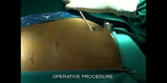 Male Breast Reduction & Correction of Gynecomastia By Dr MSVENKATESH