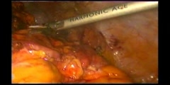 Lap Oesophagocoloplasty