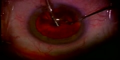 Cataract Surgery 3