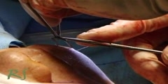 Facial Surgery Video