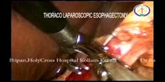 Thoraco laparosopic esophagectomy treatment
