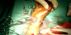 Arteriovenous malformation