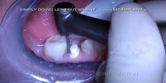 Implant torture? Watch this before you get yours done