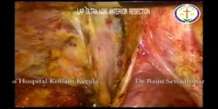 Laparoscopic ultra low anterior resection by dr baiju senadhipan