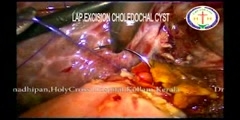 Laparoscopic choledochal cyst excistion