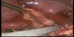 Laparoscopic Hiatus Hernia Surgery