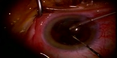 Eye Cataract Surgery
