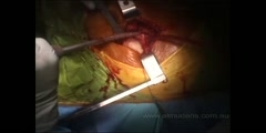 Procedure for Hip Replacement Surgery