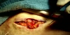 Surgery of Malar Cheek Pexing