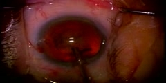 All About Cataract Surgery