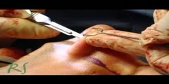 Beverly Hills Rhinoplasty Specialist performs surgery
