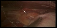 Gastric Banding via Laparoscopy