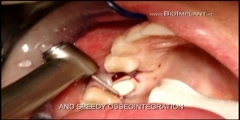 Worlds Best Immediate Zirconia Dental Implant Solution