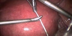 Cerclage In pregnancy laparoscopic