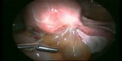 Excision of rectovaginal nodule