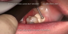 WORDS FIRST MULTI ROOTED DENTAL IMPLANT LIVE IN LESS THAN ONE MINUTE