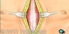 Bypass Surgery