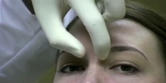 Injection Technique of Botox