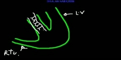 All About ECG - Arabic Part 2