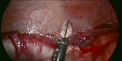 Laparoscopic Appendectomy HD Video