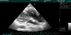 Embolism By Echocardiography