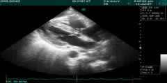 Echocardiography Shows Acute Pulmonary Embolism