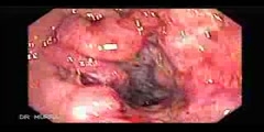 Colonoscopy of a colorectal cancer with hemorrhoids
