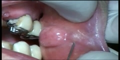 Fibroma Excision in the Cheek