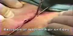 Removal of pilonidal cyst