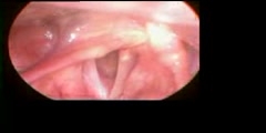 How does vocal fold paralysis look like?