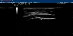 Ultrasound of Shoulder