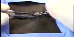 Removing skin staples with a  Skin Stapler