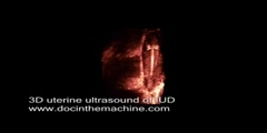 3D ultrasound of IUD in uterus video