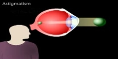 Astigmatism Causes and Symptoms Animation
