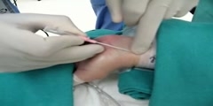 Administering Arterial line Insertion