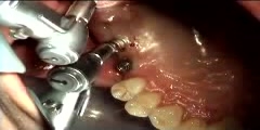 Dental Implant failure