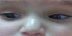congenital Nystagmus Definition