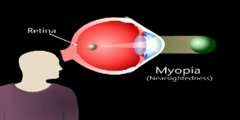 What is Myopia