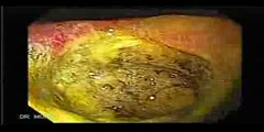 Endosocpy of a Deep Gastric Ulcer Treatment