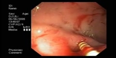 Massive Bleeding in Duodenal Ulcer